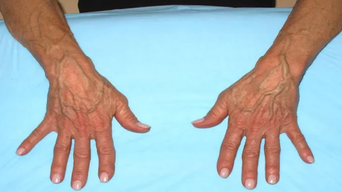 bulging-veins-in-hands